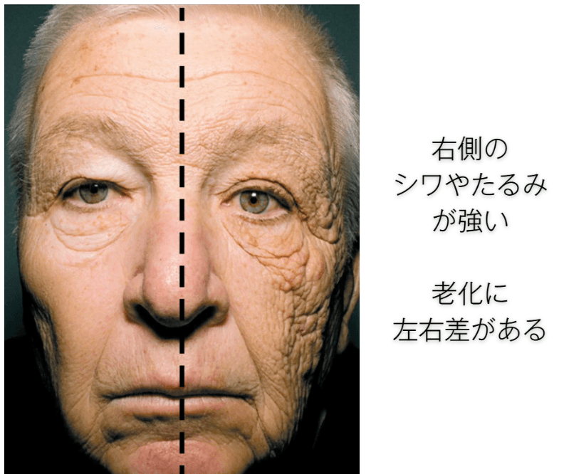 長年トラックの運転手をしていた男性の顔。運転席の窓側にあたる片側だけ、紫外線による老化（シワ・たるみ）が進行している